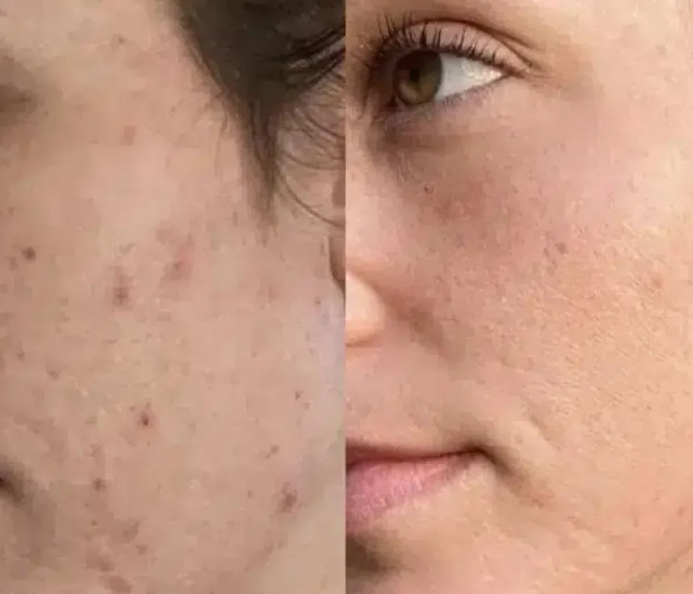 led maske akne før og efter resultater ses på kvinde