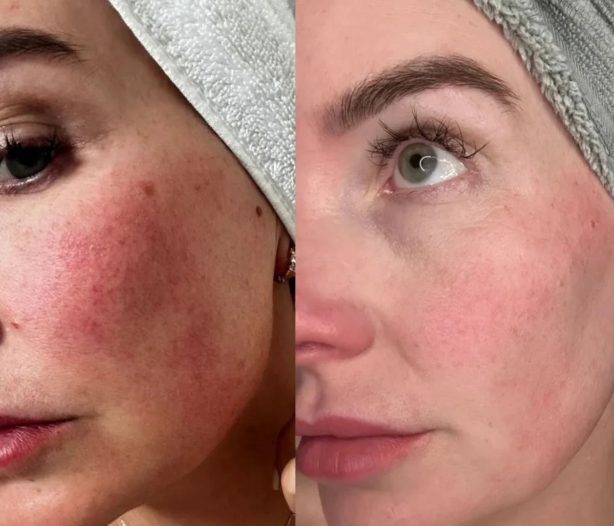 lysterapi maske rosacea før efter resultater sammenligning