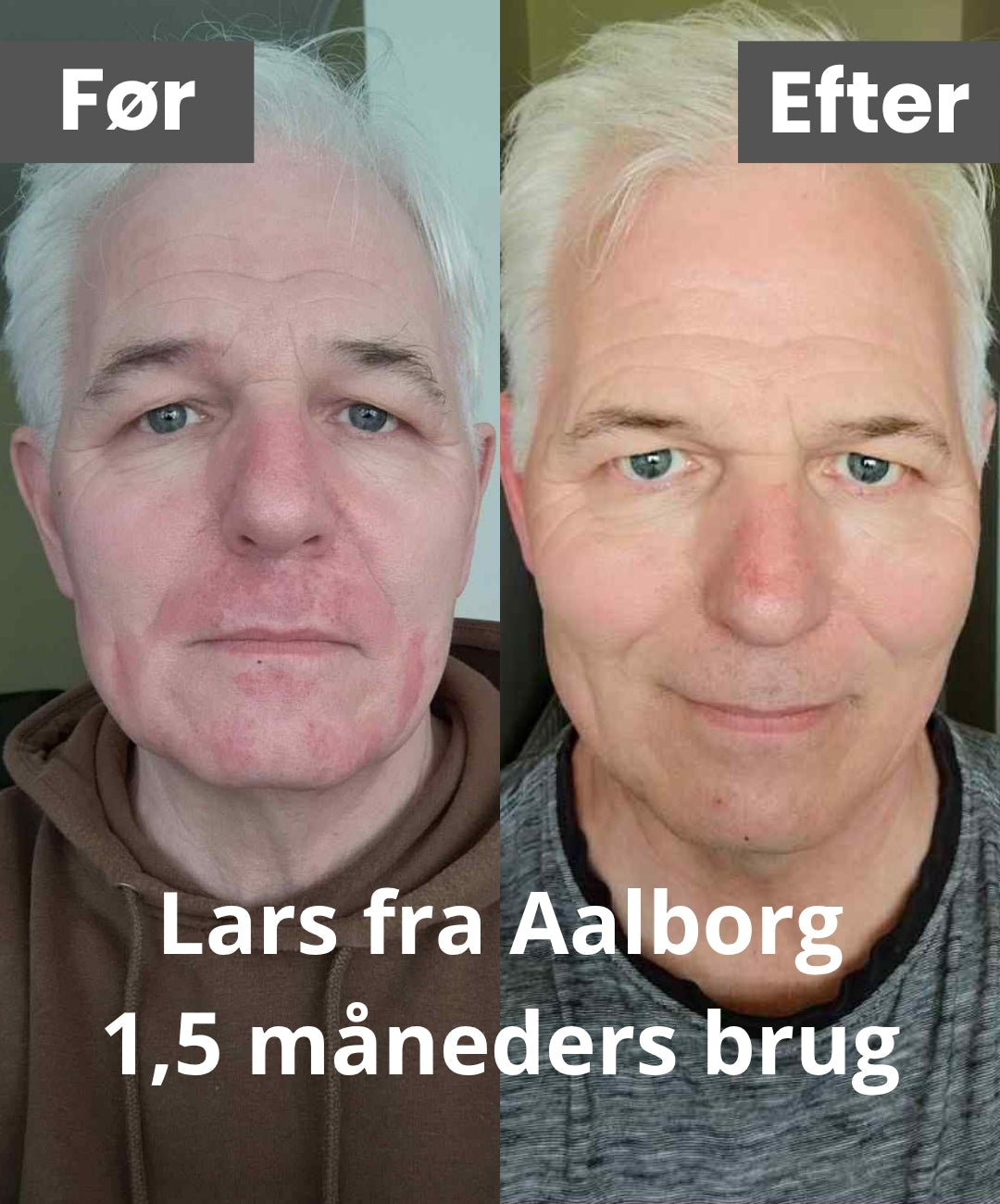 Betterskin LED Maske